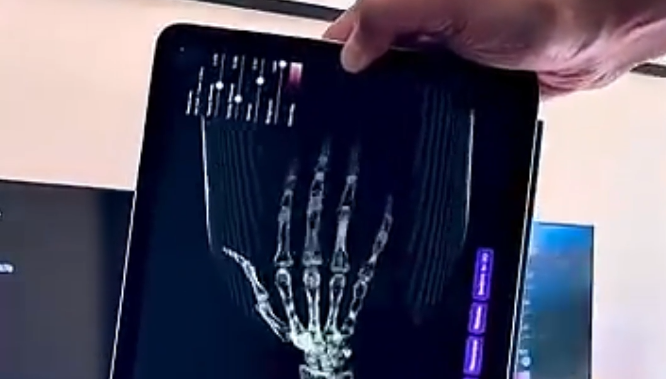 Visualização tridimensional em tempo real de exame de ressonância magnética com plano de corte físico rastreado